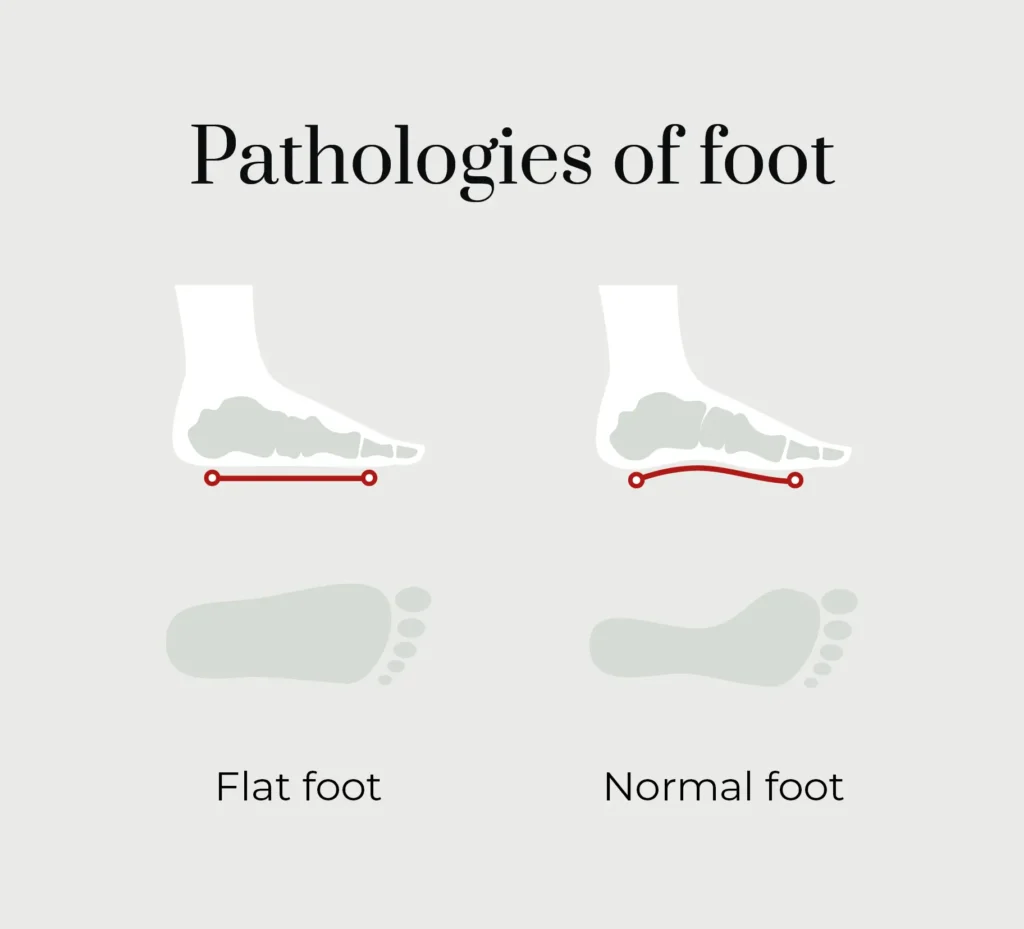 Flat Feet VA Rating